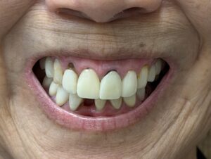 jybefore pic showing decay around old porcelain veneers
