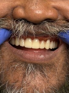 crooked full upper denture