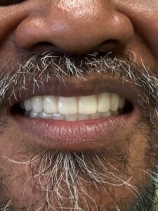 Temporary bottom all-on-x implant teeth and new full upper denture