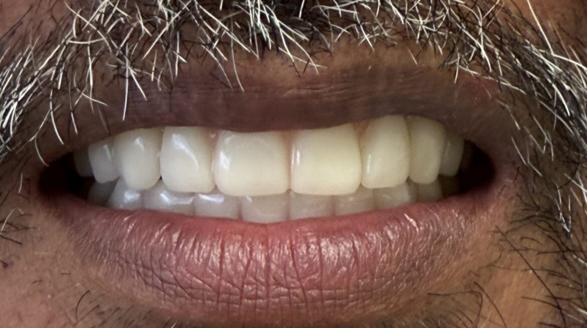 Combination All-on-X and Full Upper Denture Case