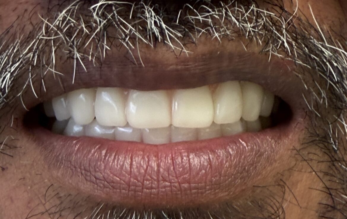 Combination All-on-X and Full Upper Denture Case