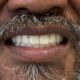 Combination All-on-X and Full Upper Denture Case