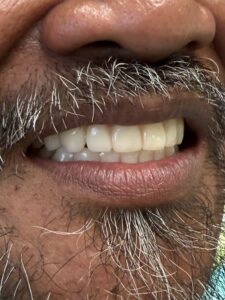 right side showing full upper denture and fixed lower implant teeth