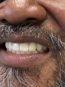 left side full upper denture and fixed lower implant teeth