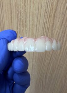 All-on-X dental implant surgery at Smile Solutions in Honolulu