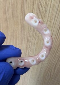 All-on-X dental implant surgery at Smile Solutions in Honolulu
