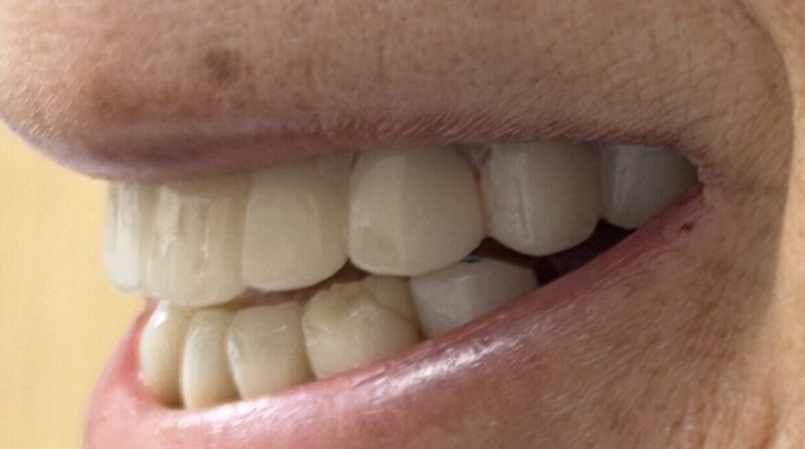 Case study for dry mouth and all-on-x dental implant surgery