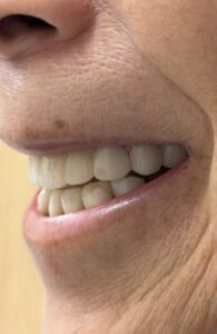 all-on-x dental implant surgery at Smile Solutions in Honolulu