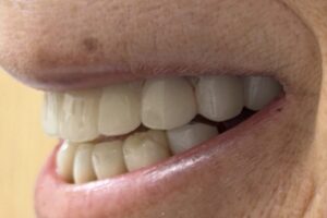 Case study for dry mouth and all-on-x dental implant surgery