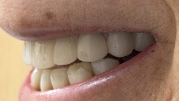 Case study for dry mouth and all-on-x dental implant surgery
