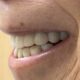Case study for dry mouth and all-on-x dental implant surgery