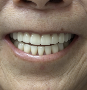 Smile Solutions dental implant case
