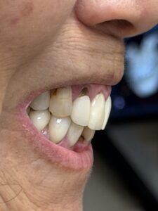 All-on-x dental implant treatments at Smile Solutions in Honolulu